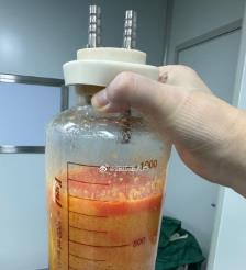 遵义水动力吸脂手术要做多久？